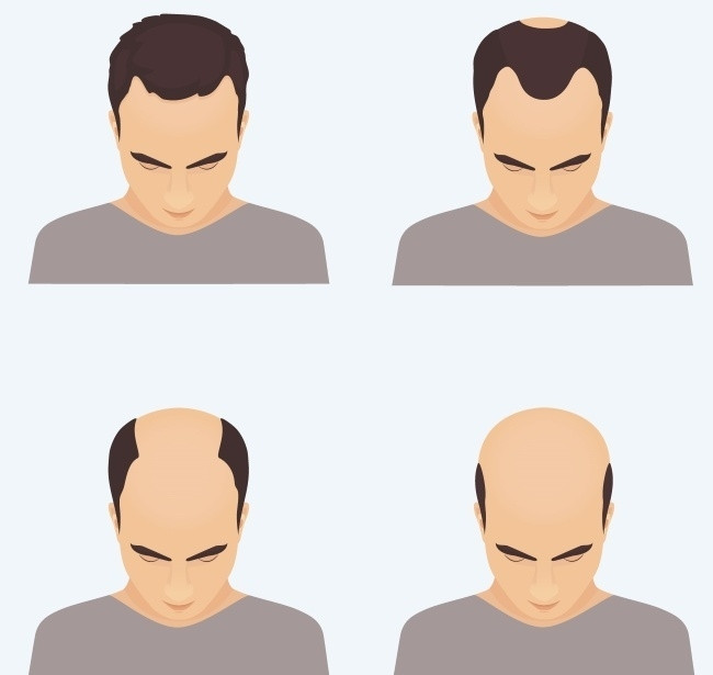 Hói đầu của nam giới có thể di truyền từ mẹ