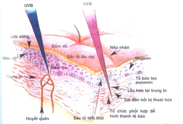 Tia UVA, UVB trong ánh nắng mặt trời gây nám da