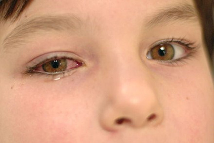 Sử dụng nhiều loại thuốc nhỏ mắt một lúc có thể gây nóng rát mắt, chảy nước mắt