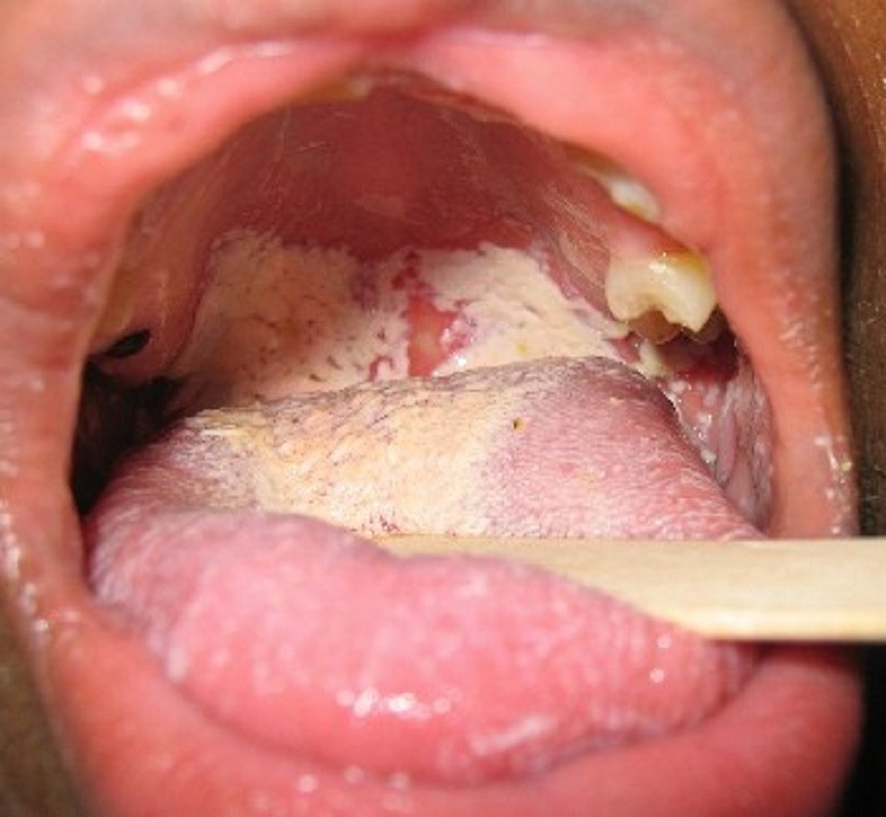 Lưỡi xuất hiện các khoảng màu trắng là dấu hiệu cho thấy bạn đang bị bệnh