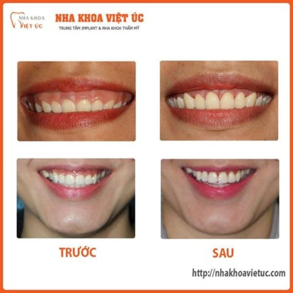 Nha khoa Việt Úc điều trị cười hở lợi thành công