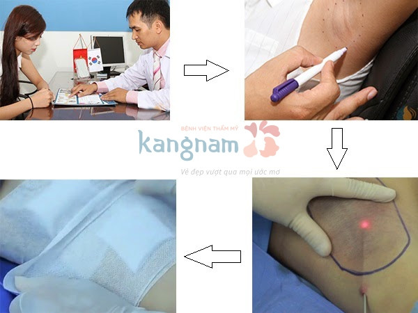 Qui trình 4 bước điều trị hôi nách tại TMV Kangnam