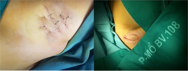 : Phẫu thuật mổ mở đường mổ nhỏ và phẫu thuật cắt vạt da