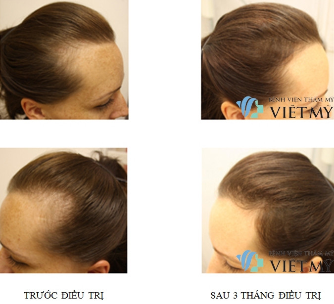 Đến TMV Việt Mỹ - rụng tóc không còn là nỗi lo