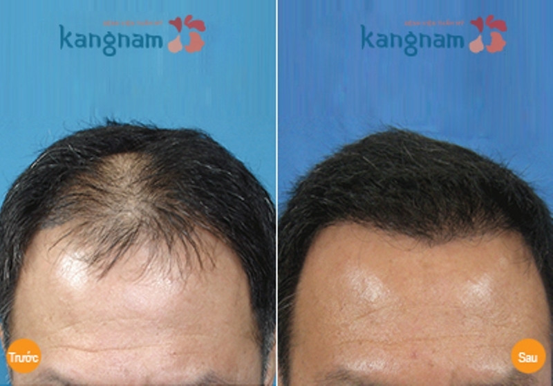 Tóc mọc dày và đều sau điều trị tại Kangnam