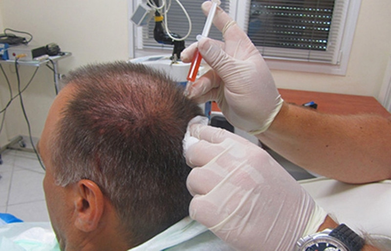 Tiến hành đưa tế bào mô được phân tách vào vùng da đầu bị hói, rụng tóc