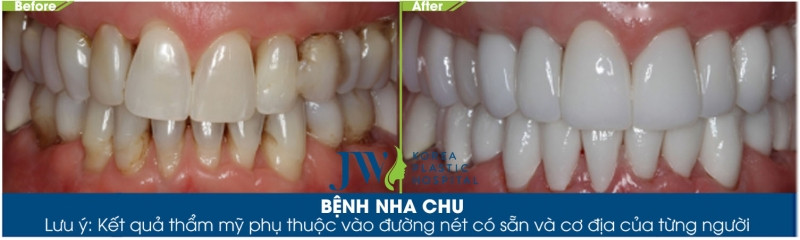 Kết quả trước và sau điều trị viêm nha chu tại nha khoa của bệnh viện JW Hàn Quốc