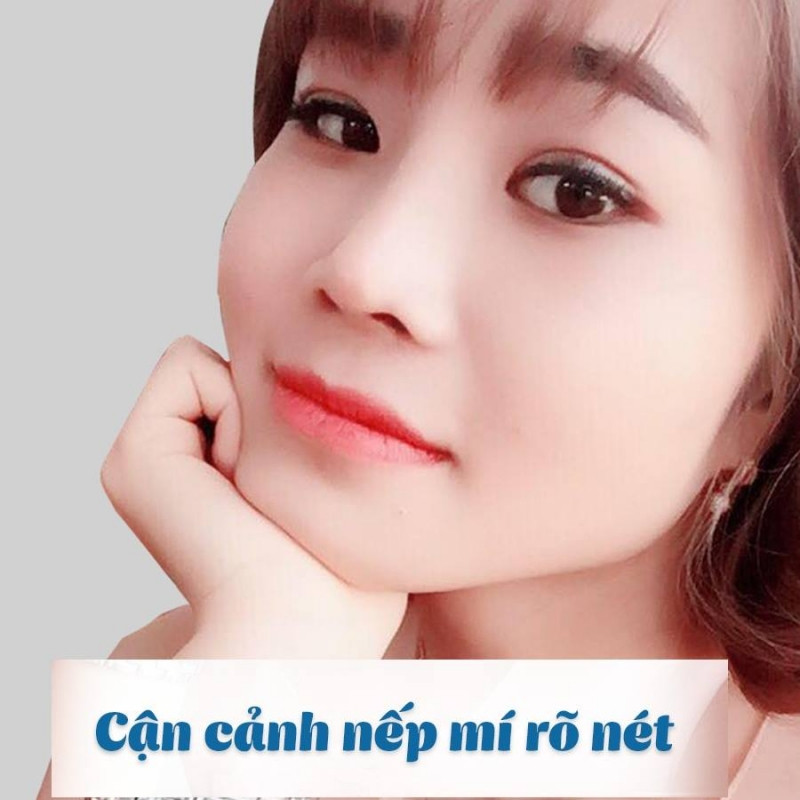 Bệnh viện thẩm mỹ Kangnam - Địa chỉ bấm mí đẹp và an toàn nhất Hà Nội