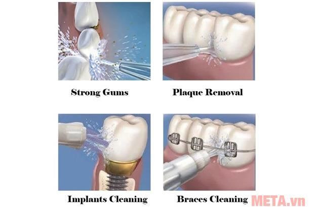 Sản phẩm còn đặc biệt phù hợp với việc vệ sinh những chiếc răng giả, đang niềng răng, cấy ghép răng bởi áp lực tia nước, những chiếc răng sẽ được thoải mái tắm mát bằng làn nước trong lành