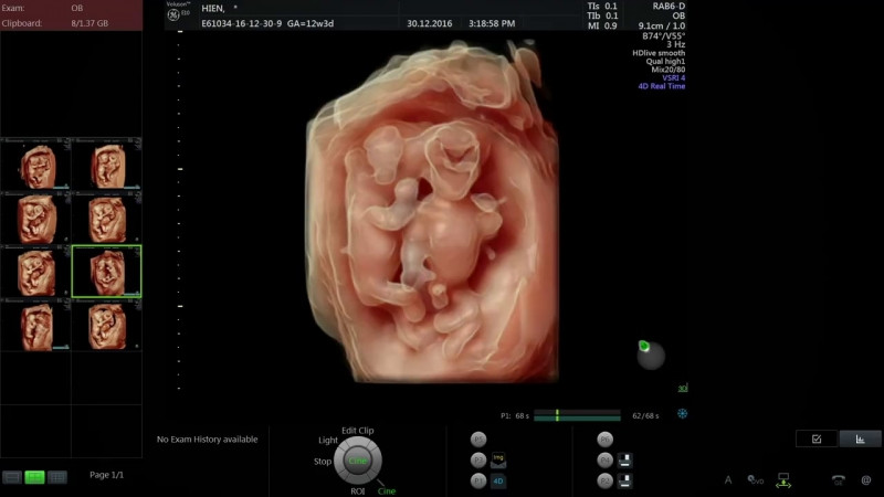 Siêu âm 4D tuần 12 kiểm tra bất thường hình thái thai nhi