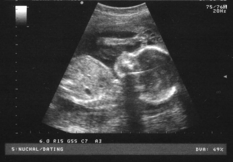 Hình ảnh thai nhi 20 tuần tuổi
