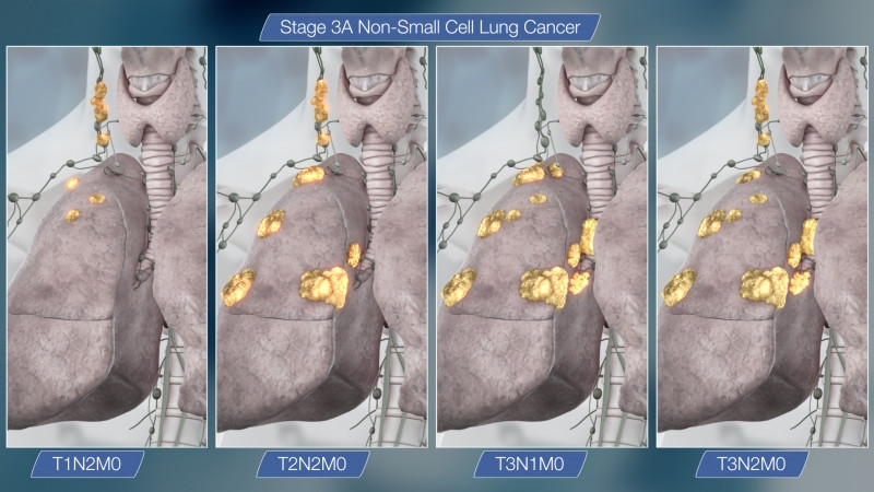 Ung thư phổi giai đoạn 3A