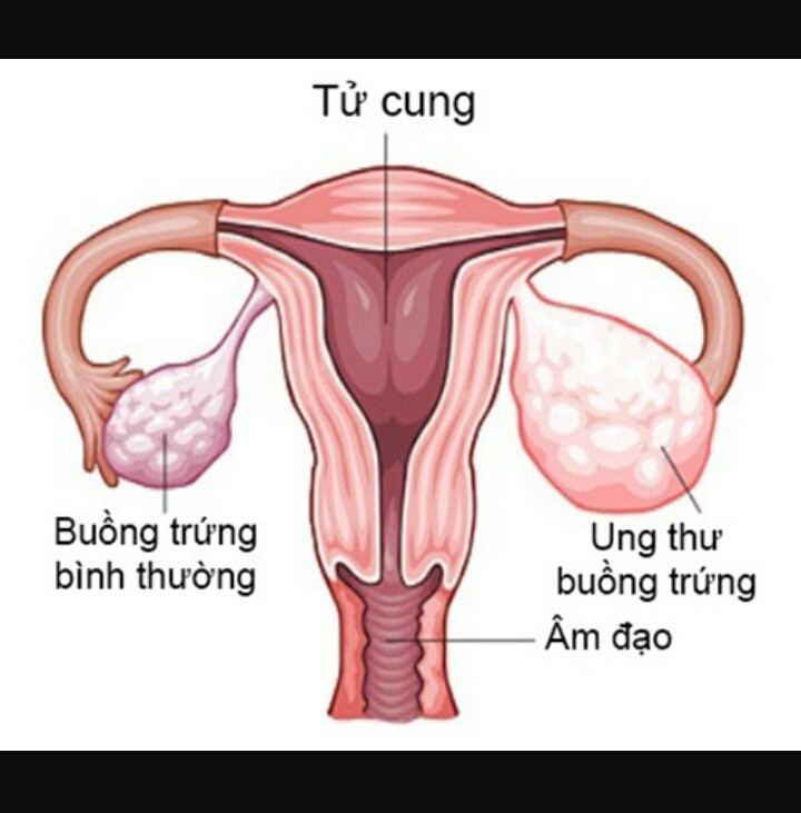 Những bất thường của buồng trứng nữ giới khi bị ung thư