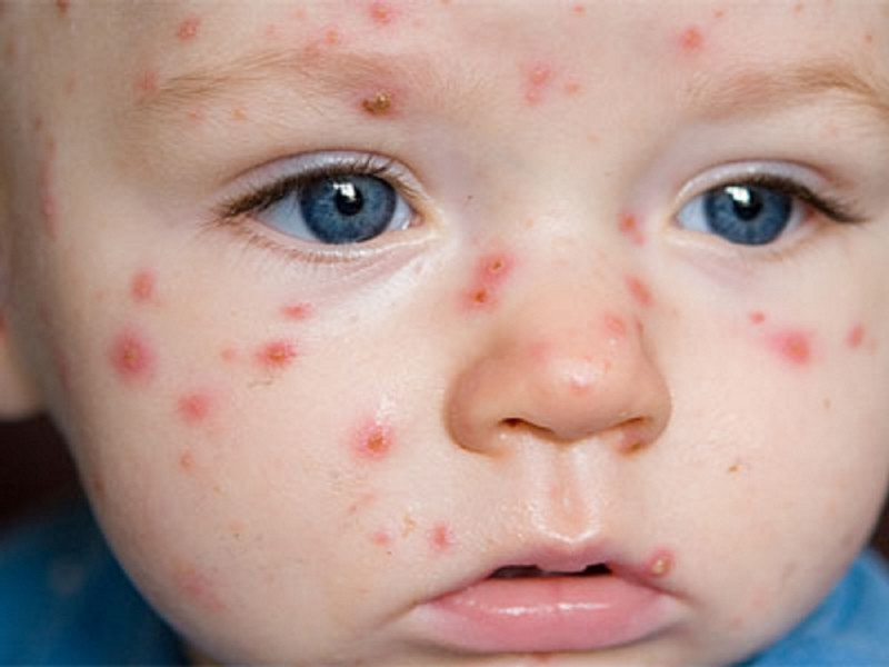 Trẻ nhỏ bị nhiễm thuỷ đậu, mặt xuất hiện nhiều nốt đỏ.