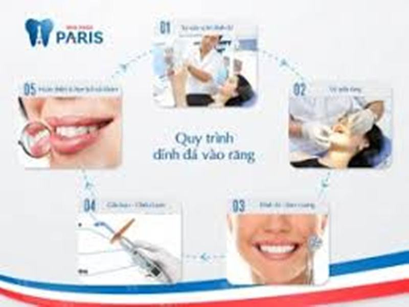 Quy trình đính đá lên răng tại nha khoa Paris
