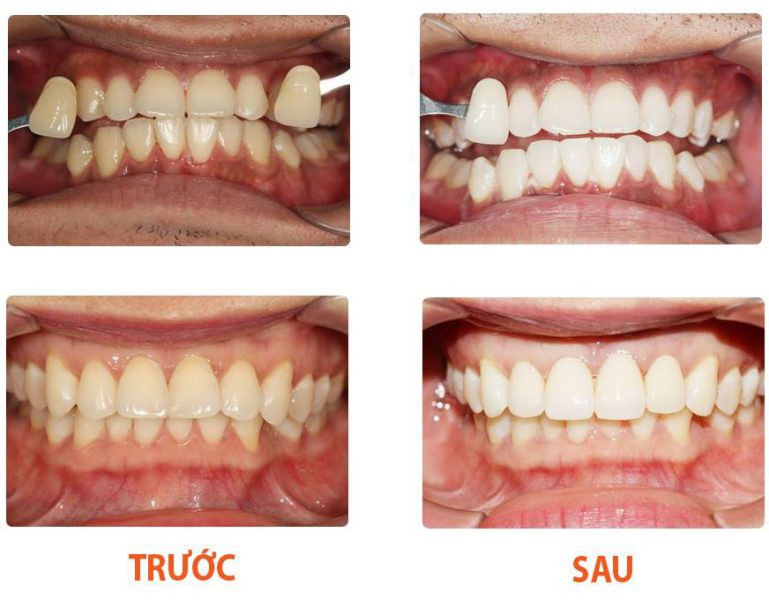 Hình ảnh khách hàng tẩy trắng răng tại Bệnh viện Thái Thượng Hoàng