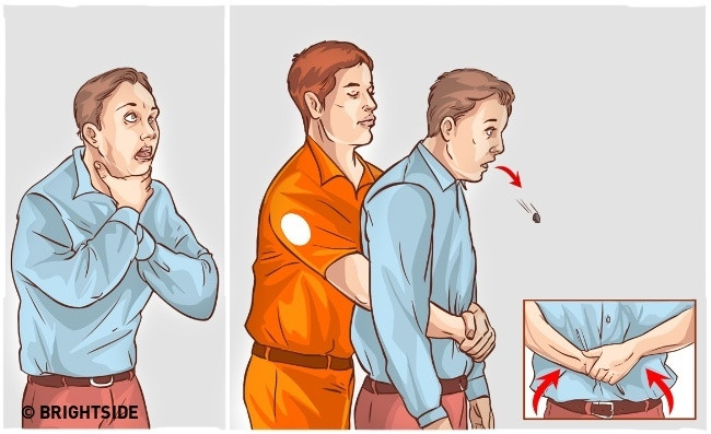 Ngăn chặn nguy cơ bị nghẹt thở bằng phương pháp giật bụng (Heimlich maneuver)