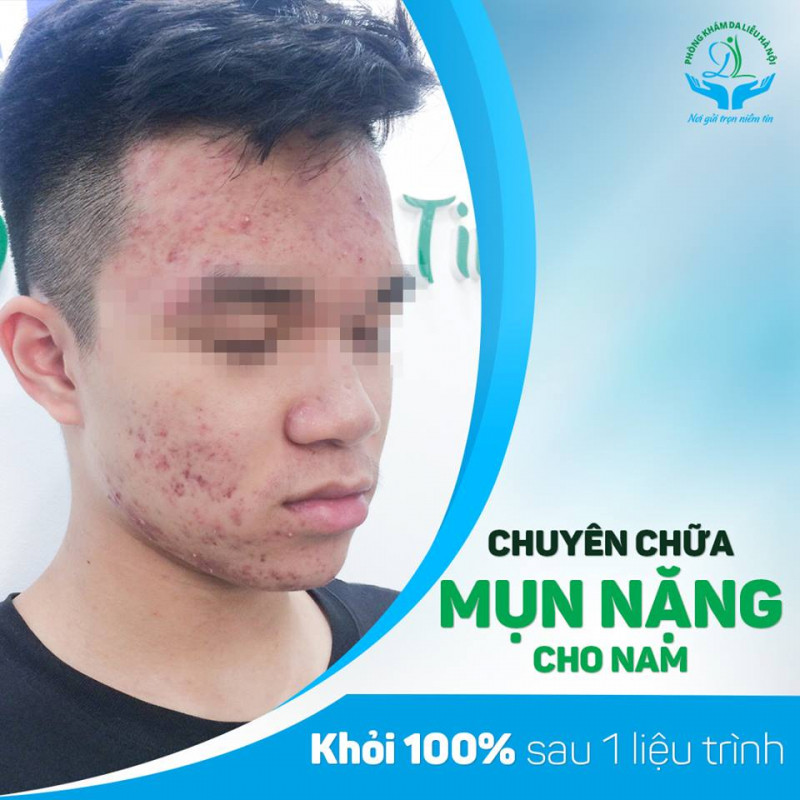 Điều trị mụn tại Phòng Khám Da Liễu Hà Nội, cam kết khỏi 100% sau 1 liệu trình