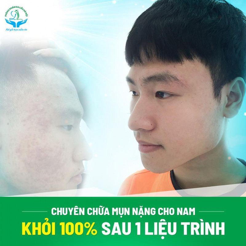 Điều trị mụn tại Phòng Khám Da Liễu Hà Nội