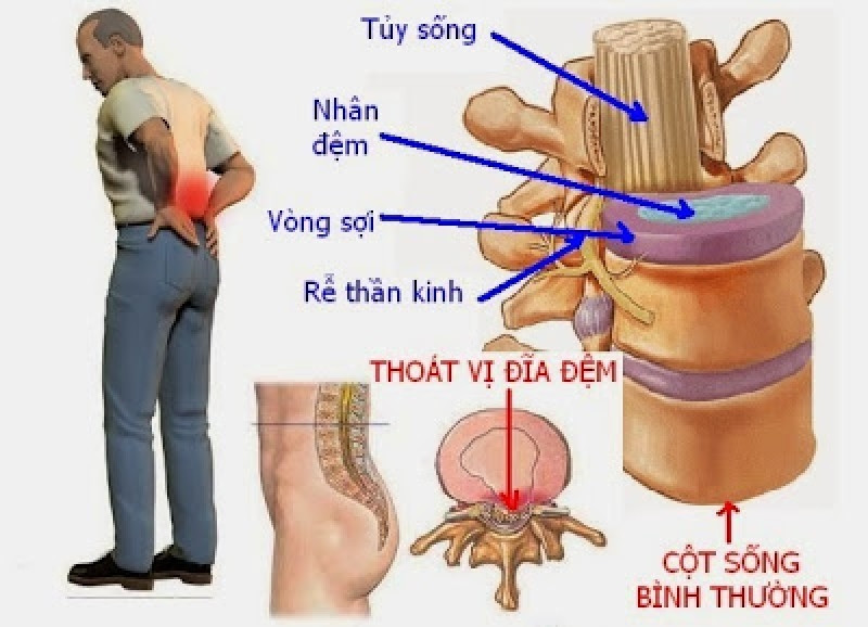 Thoát vị đĩa đệm do chiều cao