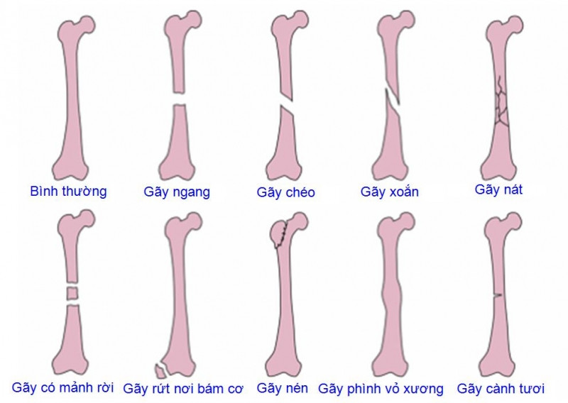 Các biểu hiện của gãy xương