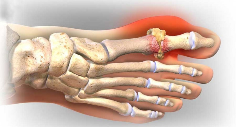 Bệnh Gout gây sưng đau giữa khớp ngón chân