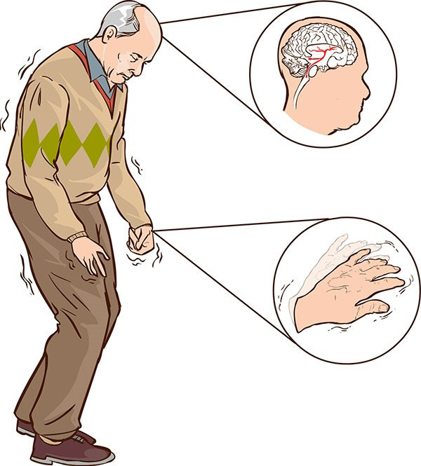 Bệnh Parkinson ảnh hưởng xấu tới sức khỏe, sinh hoạt của con người