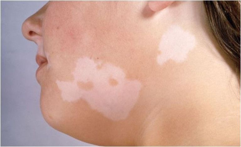Bệnh lang ben có biểu hiện là trên bề mặt da người bệnh có vẩy mịn. Vị trí thường bị bệnh là vùng cổ, ngực, mặt, lưng, đùi,...