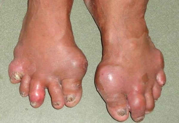 Sưng phù ở tay, chân là biểu hiện của bệnh gout