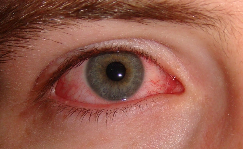 Đau mắt đỏ là bệnh theo mùa