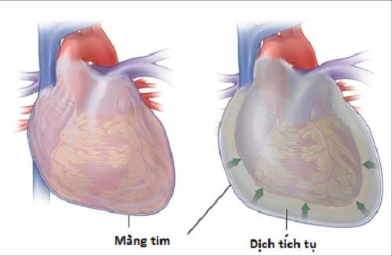 Viêm màng ngoài tim được hiểu là viêm kích thích của màng ngoài tim