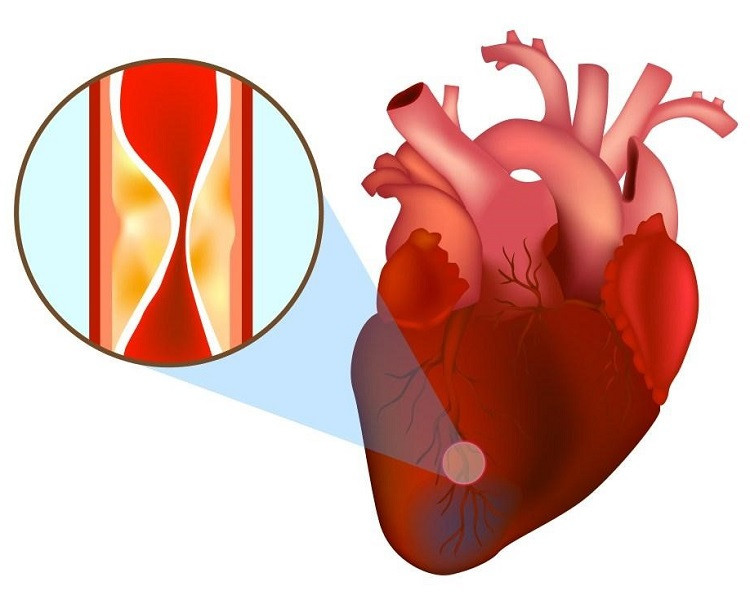Nhồi máu cơ tim xảy ra là do mạch vành bị tắc nghẽn bởi cục máu đông