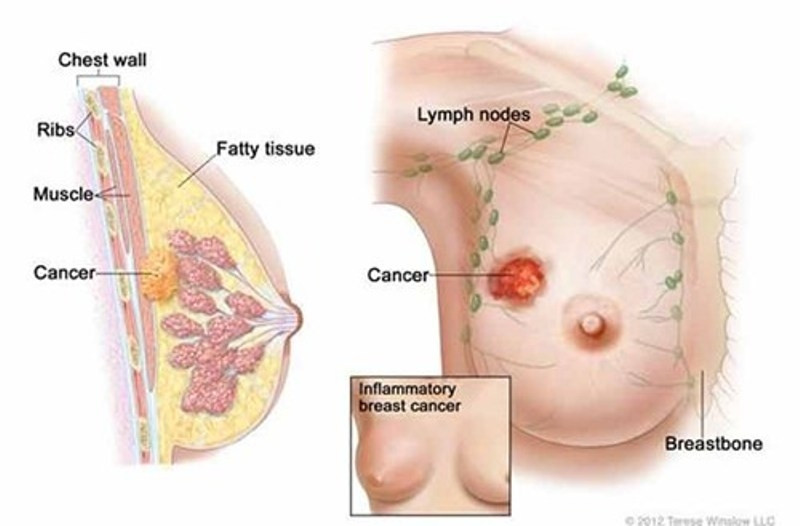 Hình ảnh khối ung thư trong vú
