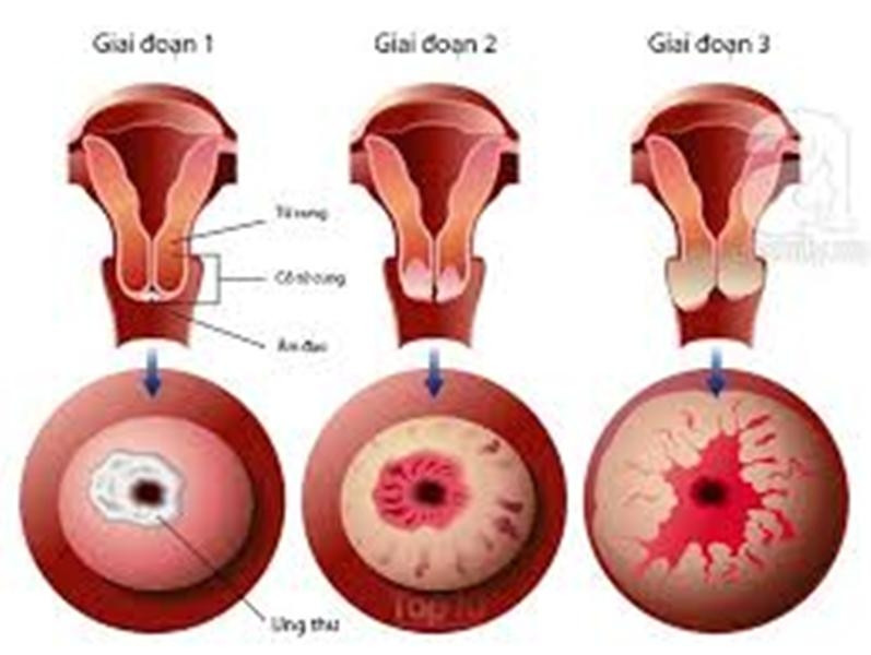Hình ảnh các giai đoạn của ung thư cổ tử cung