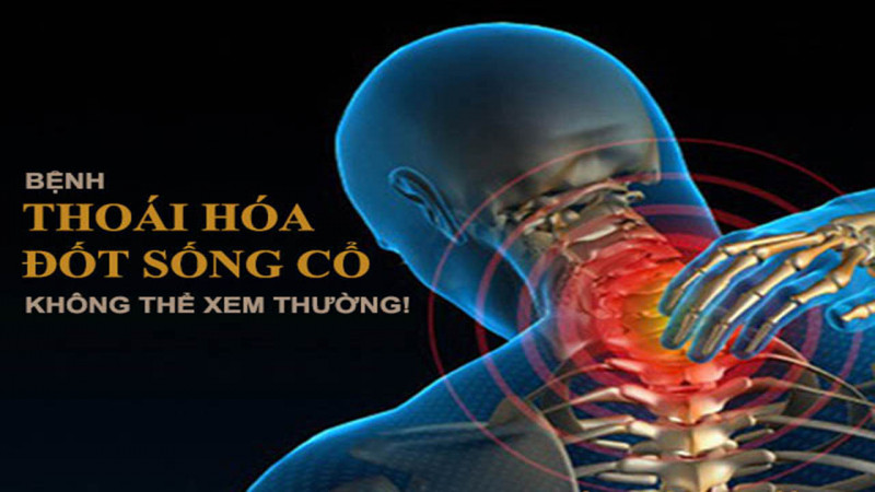 Thoái hóa đốt sống cổ