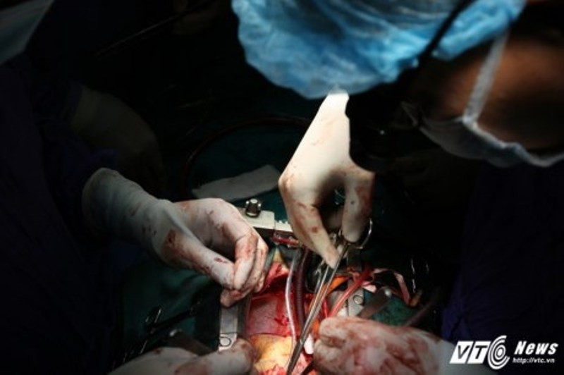 Hình ảnh phẫu thuật tim tại bệnh viện Việt Đức