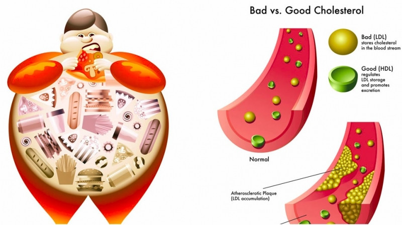 Cholesterol có hại gây ảnh hưởng xấu đến cơ thể