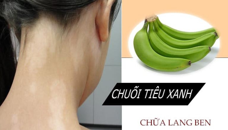 Chuối xanh có thể được coi là một loại thuốc dân gian chữa lang ben hiệu quả nhất.