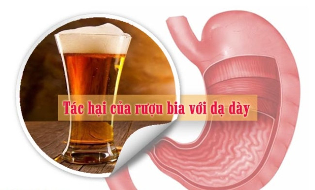 Uống nhiều rượu bia, sẽ kích thích tiết ra lượng acid nhiều khiến niêm mạc dạ dày bị tổn thương