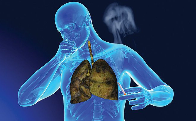 Bệnh về phổi gây ho nhiều sẽ làm tăng nguy cơ mắc trĩ