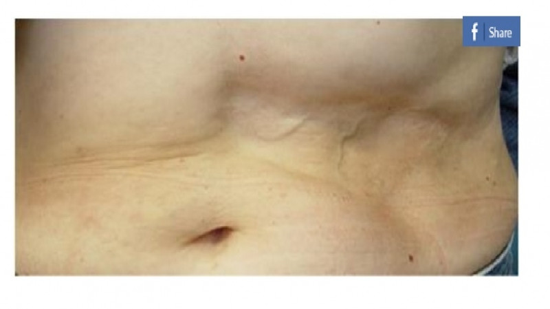 Hình ảnh một phần da của bệnh nhân mắc chứng loạn dưỡng mỡ chi dưới