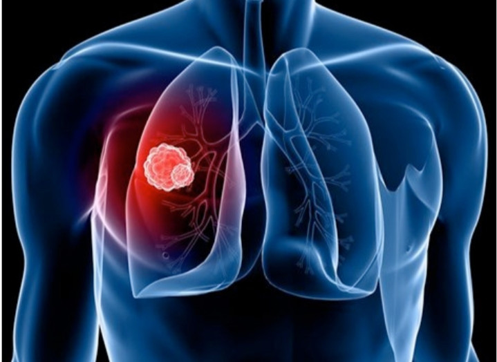 Hầu hết nguyên nhân gây ung thư phổi chủ yếu từ thuốc lá