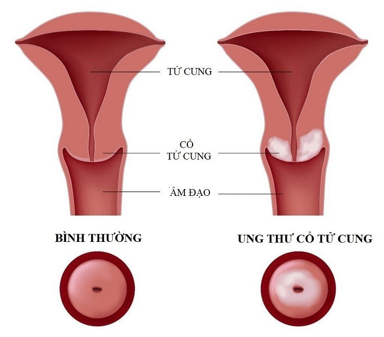 So sánh giữa cổ tử cung bình thường và cổ tử cung bị ung thư