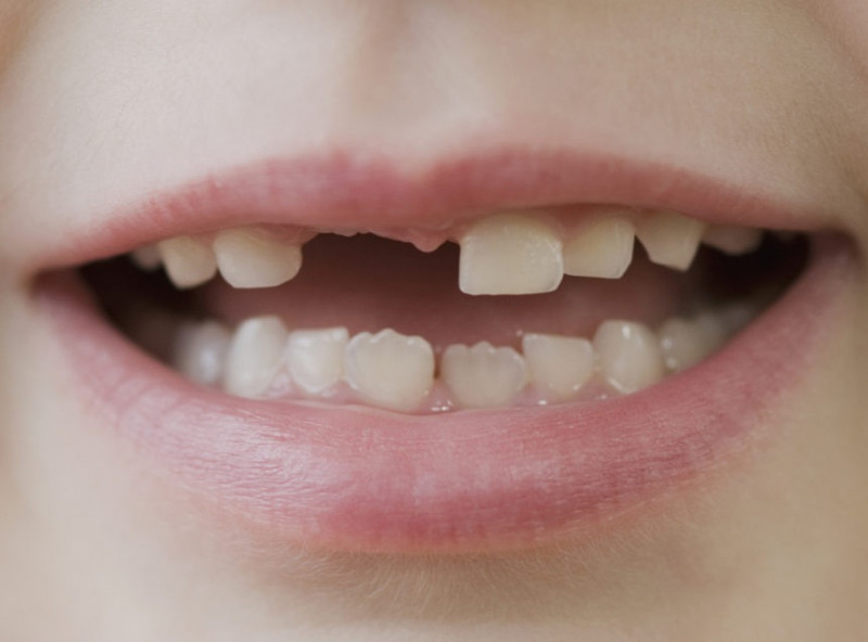 ﻿Tetracyclin gây đổi màu răng ở trẻ