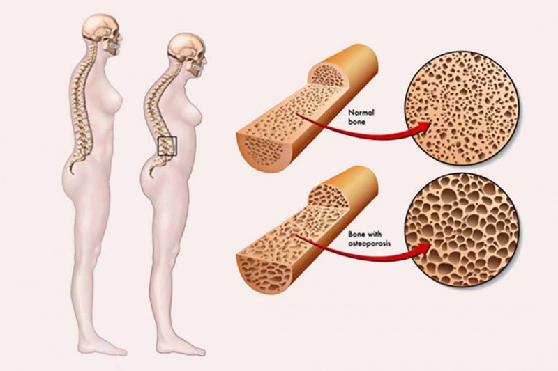 Sử dụng tinh dầu hoa anh thảo kết hợp Canxi sẽ giúp tăng mật độ xương