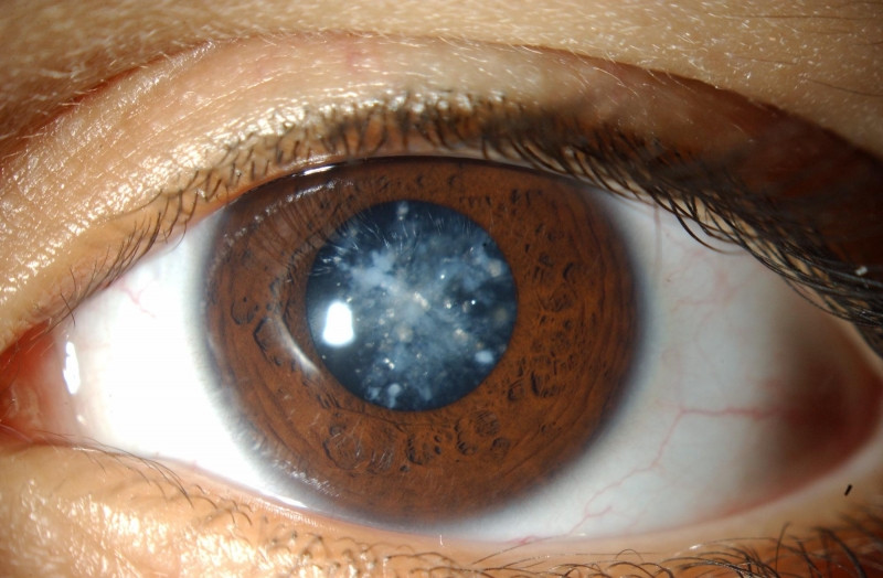 Mắt nhìn thấy các đốm, vệt báo hiệu nhiều bệnh nguy hiểm liên quan đến mắt