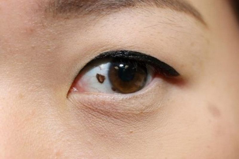 Khi mắt bạn nhìn thấy những đốm, vệt bạn cần khắc phục đốm đen trong mắt.