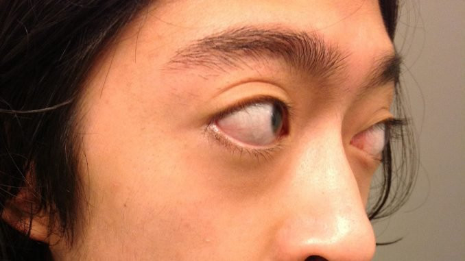 mắt lồi to cũng là một dấu hiệu cho thấy bạn đang mắc bệnh Graves