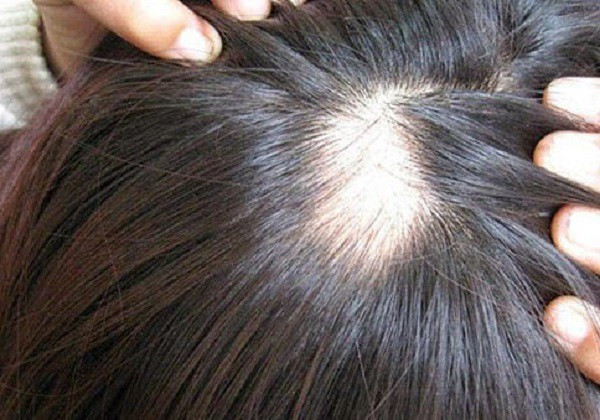 Rụng tóc nghiêm trọng cảnh báo bệnh