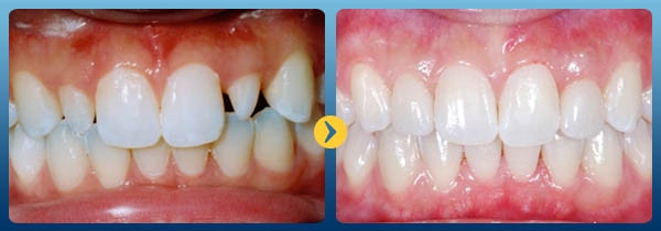 Kết quả đã đạt được khi sử dụng dịch vụ bọc răng sứ tại Nha khoa Kim